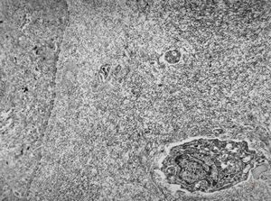 M,2m. | undefined hereditary syndrome, multiplied anomalies, sibling Bcornea - keratopathy … missing Bowman membrane, disorganized stromal architecture